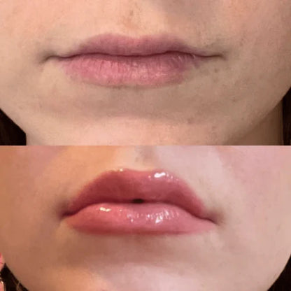 Lip Plumper